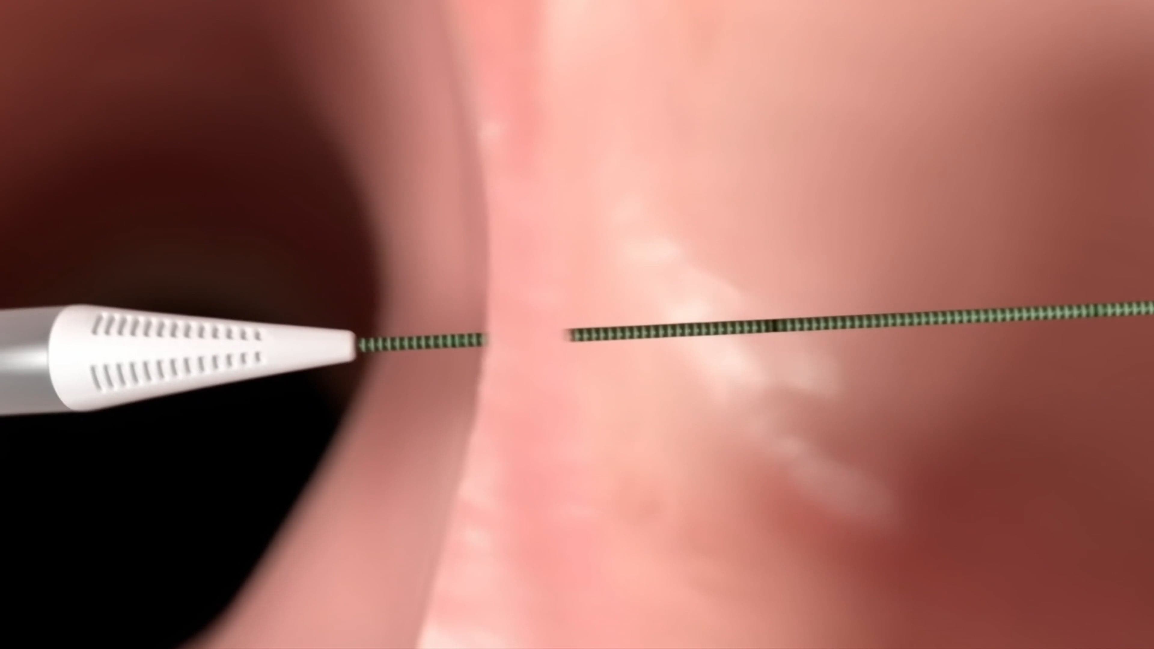 How is the Alleviant shunt created